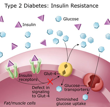 Type 2 Diabetes: Insulin Resistance