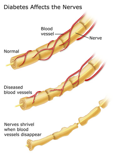 How diabetes affects the nerves