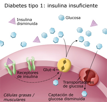 Diabetes tipo 1: Insulina insuficiente