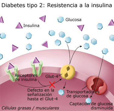Diabetes tipo 2: resistencia a la insulina