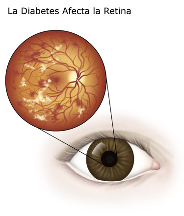 Cómo afecta a la retina la diabetes