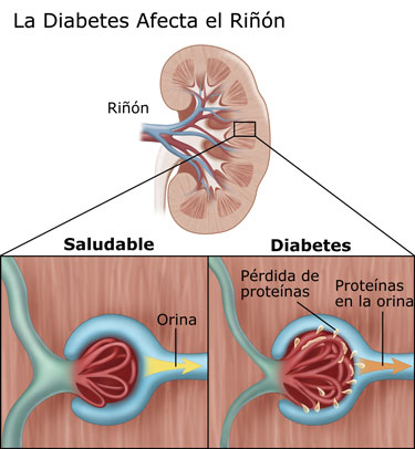 La diabetes afecta a los riñones