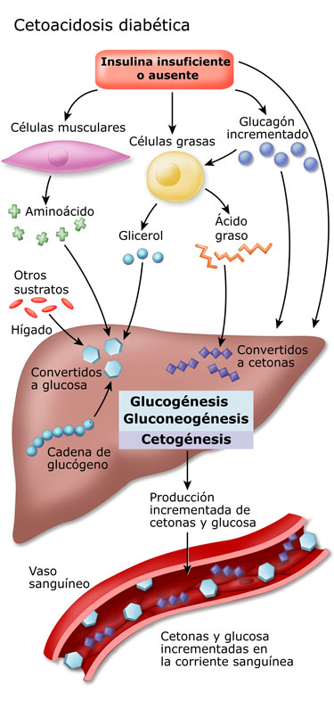 cetoacidosis diabética