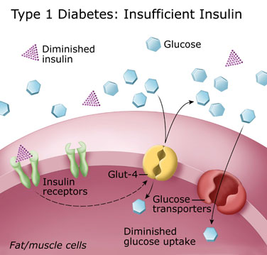 Type 1 diabetes: Insufficient Insulin