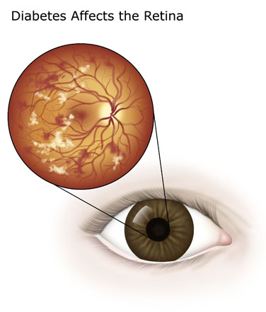 How Diabetes affects the retina